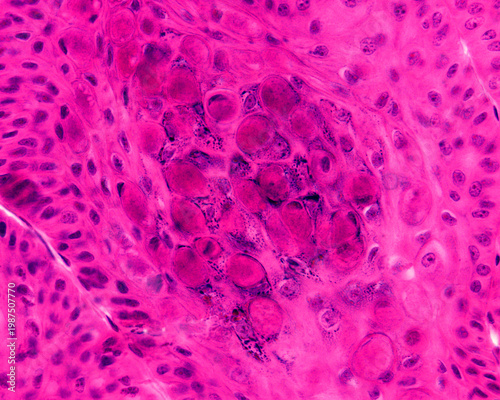 Eyelid skin. Molluscum contagiosum
