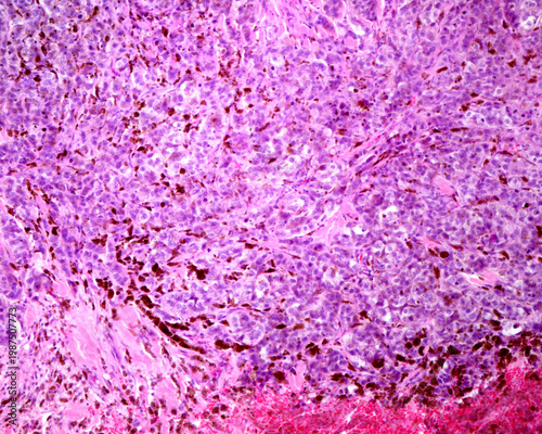 Human skin melanoma