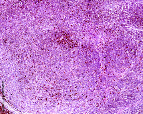 Human skin melanoma