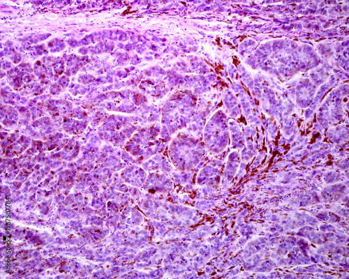 Human skin melanoma