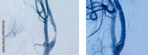 Canvastavla Angiographic images showing arterial stenosis and stent placement comparison for