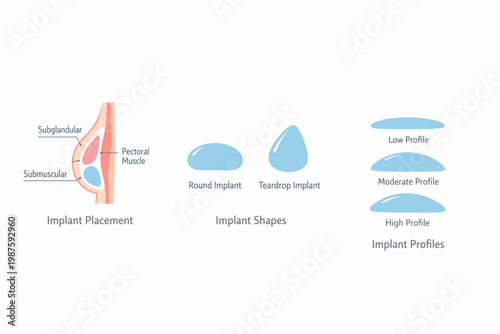 Breast implant placement, shapes, and profiles overview