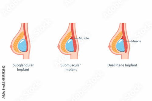 Comparison of subglandular, submuscular, and dual plane breast implants diagram