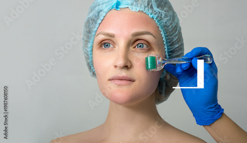 Foto Mesotherapy by microneedling