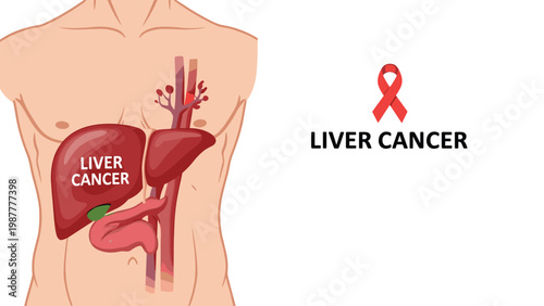 Human torso diagram shows liver cancer with a red awareness ribbon next to the text, focusing on medical diagnosis and health.