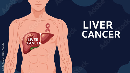 Detailed medical illustration of human liver cancer with a tumor and an awareness ribbon, focusing on oncology and healthcare.