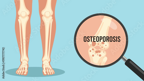 Magnifying glass shows a detailed view of a bone affected by osteoporosis in a persons legs, focusing on medical diagnosis.
