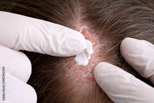 Dermatologist's gloved hands applying topical cream medication to a patient's inflamed, red, and scaly scalp affected by psoriasis or eczema, close-up view of skin treatment.