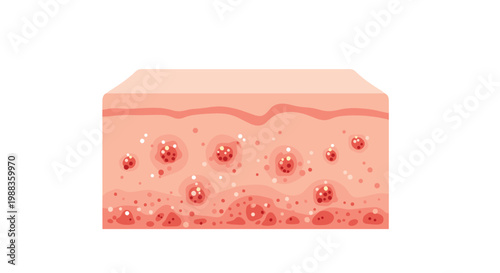 A detailed anatomical cross-section diagram displays various layers of human skin tissue affected by deep red inflammation and white pore blockages on white.