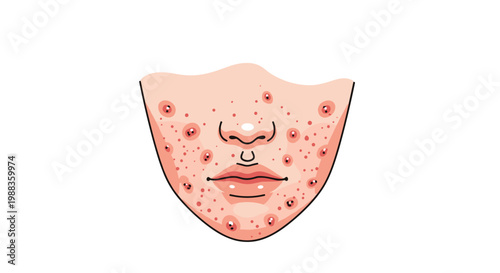 A focused illustration of the lower facial region captures a nose and mouth surrounded by numerous red acne spots and blemishes on a white background.