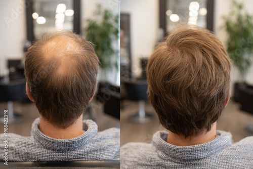 before and after transformation of a man doing scalp treatment in a professional salon