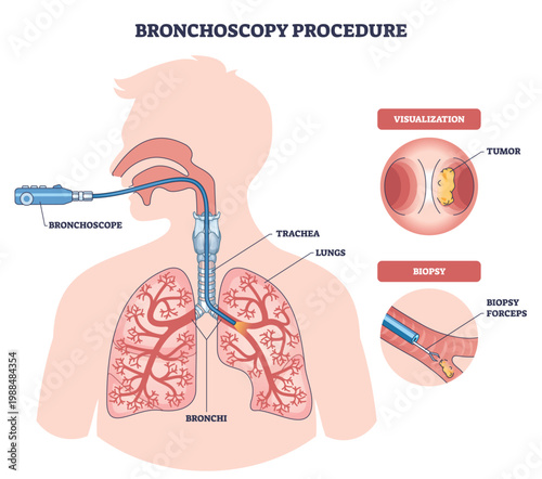 Bronchoscopy procedure illustrated, airflow pathway and tumor biopsy shown as a scope passes through trachea into lungs, key elements are bronchoscope, bronchi, biopsy forceps. Outline diagram