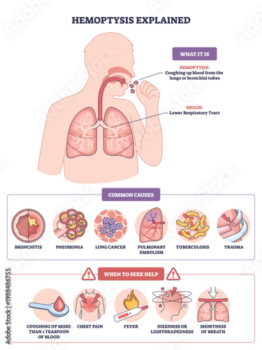 Hemoptysis explained, lungs, bronchial airway, and coughing blood illustrate causes and urgent warning signs in a clear medical graphic. Outline diagram
