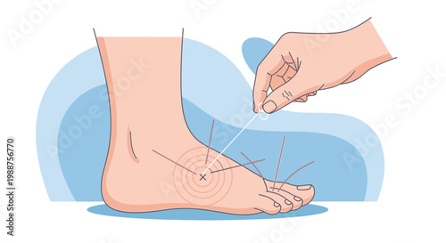 Acupuncture treatment for foot pain, alternative medicine, needle therapy on sole