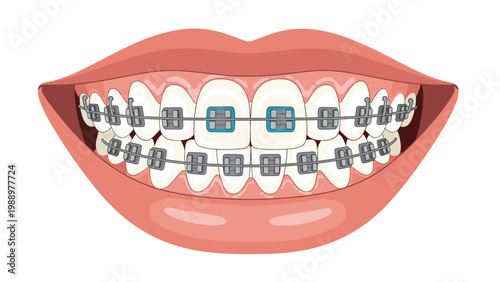 Detailed illustration of an open mouth with perfectly aligned teeth, fitted with modern dental braces, representing orthodontics and oral health.