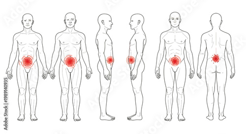 Vector graphic illustration of male anatomical outlines highlighting common prostate or lower abdominal and back pain.