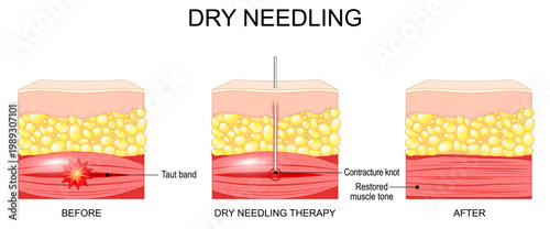 Dry needling. Skin and Muscle before and after dry needling therapy.