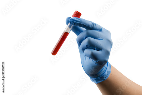 test tube with donor blood in doctor's hand on blue background. gloves hold a flask of blood for a cholesterol and infection test.medical research and development..