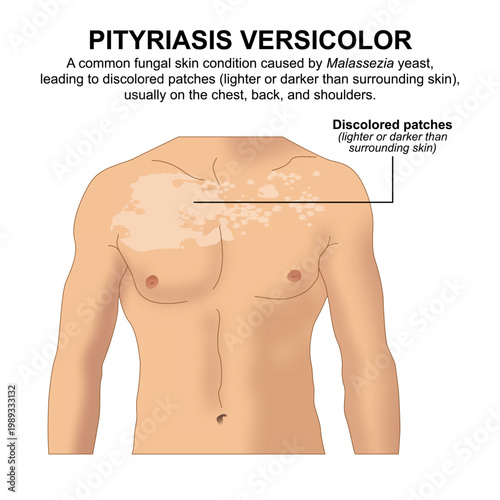 Pityriasis Versicolor, Skin flashcard illustration