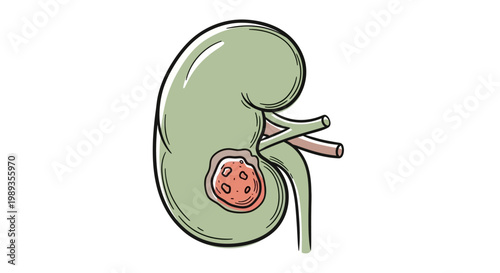 Medical Illustration of Human Kidney with a Tumor or Lesion.