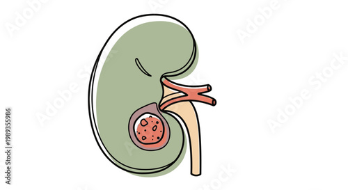 Illustration of a human kidney affected by a disease or condition.