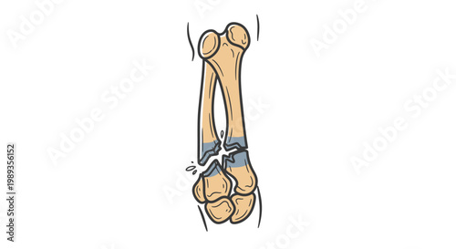 Medical Illustration of Supracondylar Humeral Fracture.