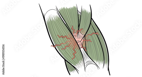 Medical illustration showing muscle injury and inflammation in the human leg.