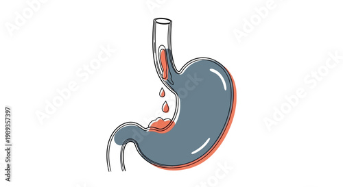 Medical illustration of a human stomach with internal bleeding and gastric ulcer.