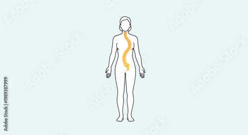 Human body outline with highlighted spine showing scoliosis.