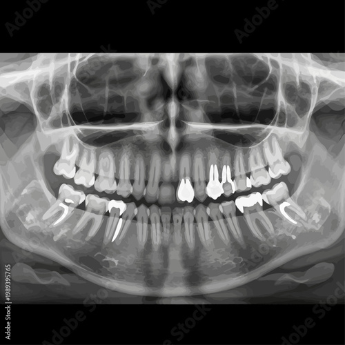 X-ray image of a human skull showing teeth and jawbone structure with dental implants
