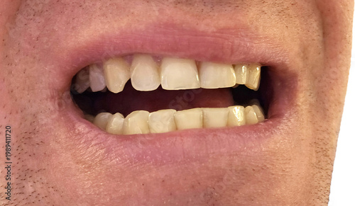 Schilderij op canvas Close up of adult man mouth with crooked yellow teeth and malocclusion before orthodontic treatment