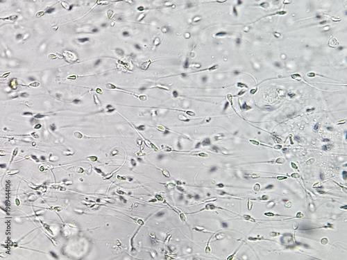 Tablou pe pânză Sperm analysis on microscopic examination, Normozoospermia, normal semen analysis