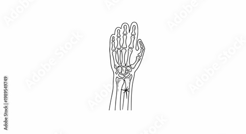 Medical illustration of human hand and wrist bones with fracture detail