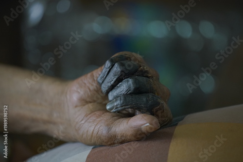 showing third-degree frostbite, or congelatio gangraenosa, on a human hand. This is the most severe stage of frostbite.  Congelatio gangraenosa involves irreversible damage to the skin, muscles