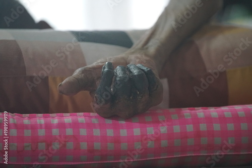 showing third-degree frostbite, or congelatio gangraenosa, on a human hand. This is the most severe stage of frostbite.  Congelatio gangraenosa involves irreversible damage to the skin, muscles