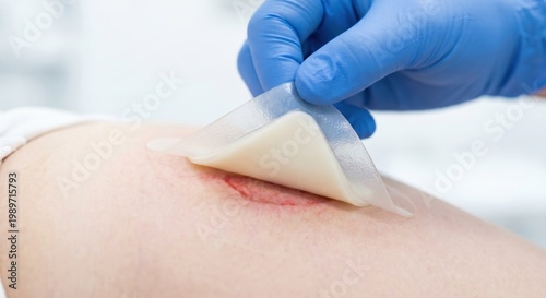 Nurse applying silicone foam dressing to patient pressure ulcer