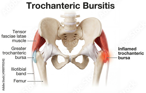 Trochanteric Bursitis. Inflamed Hip Bursa Anatomy Diagram with Iliotibial Band and Femur. Labeled