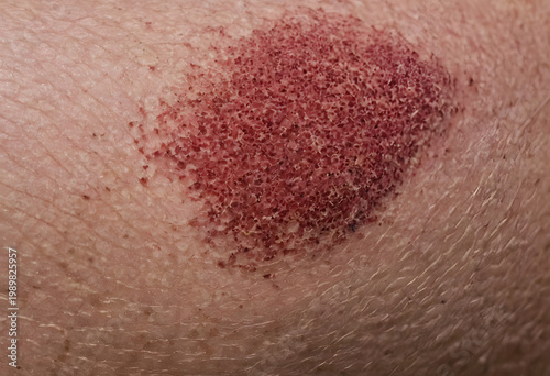 Skin abrasion showing injured human skin texture
