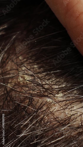 Scalp dandruff and seborrheic dermatitis examination. Closeup of flaky itchy head skin with hair, vertical video