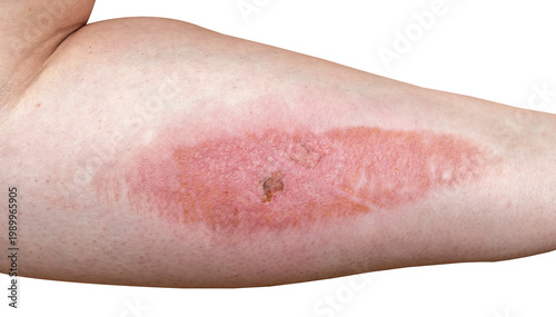 Photos Burn on female arm skin close up macro isolated on white background
