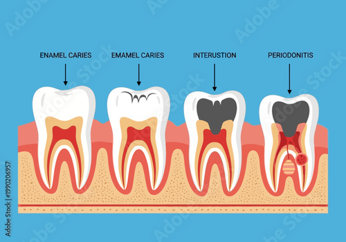 Stages of Tooth Decay Illustration: Progression from Enamel Caries to Periodontitis and Dental Abscess in Human Teeth Anatomy Diagram
