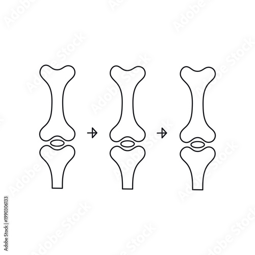Illustration of progressive stages in bone fracture healing with joint involvement