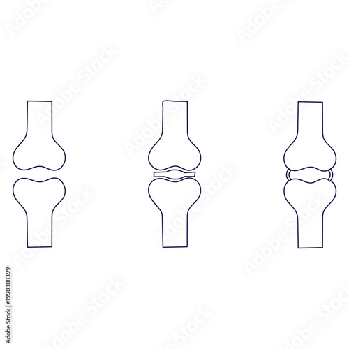 Illustration of knee joint conditions and prosthetic replacements shown in sequence