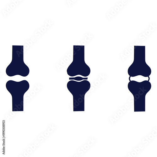 Illustrations of knee joints in different conditions and states of repair or damage