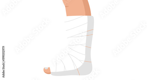 Illustration of a leg wrapped in a white plaster cast against a plain background, showcasing medical support and healing process