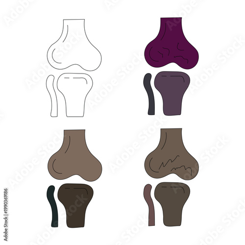Illustrations of knee joint conditions and replacements in different stages