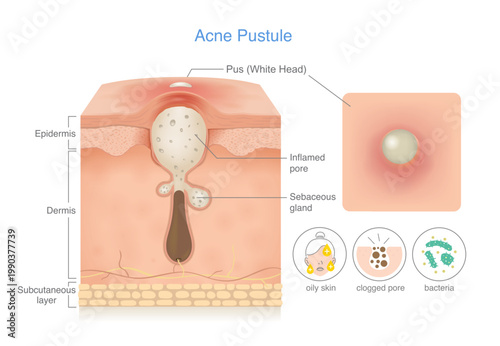 Skin layer anatomy of Acne pustule (whitehead). Clogged pore filled with pus can see at skin surface, Inflamed pore. Icon of cause of this acne problem included oily skin, bacteria and clogged pore.