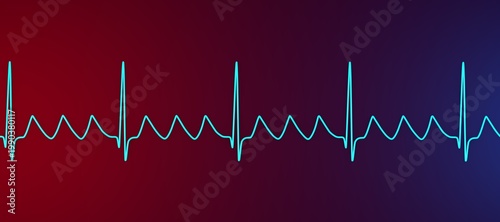 Atrial flutter ECG, 3D illustration, electrocardiogram tracing showing regular sawtooth flutter waves between QRS complexes.