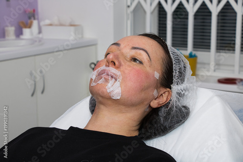 Anesthesia with a lip augmentation applicator. Close-up of a woman.