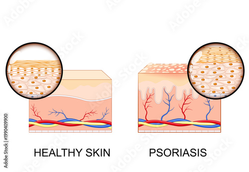 Psoriasis. Healthy Skin and Autoimmune Skin Condition